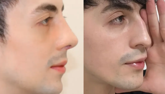 اصلاح پشت لب بعد از عمل بینی