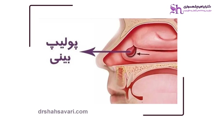 جراحی پولیپ بینی چیست؟