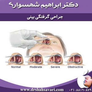 جراحی گرفتگی بینی