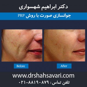 پی آر پی یا پلاکت درمانی