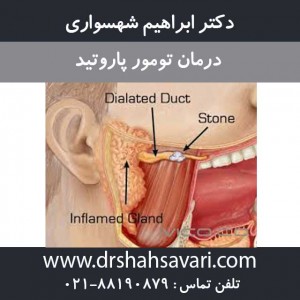 درمان تومور پاروتید
