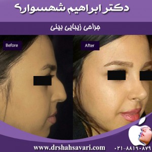 تقویت غضروف بینی