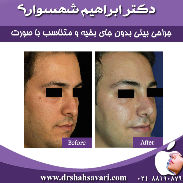 جراحی بینی گوشتی