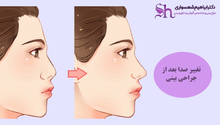 علت تغییر صدا بعد از جراحی بینی