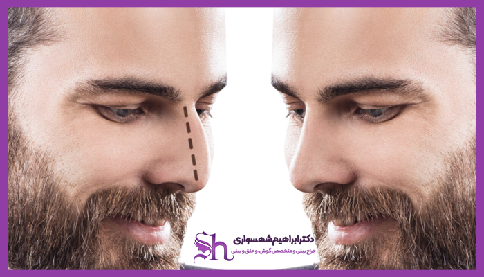 قیمت عمل بینی مردانه
