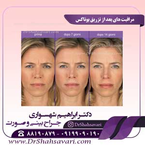 مراقبت های بعد از تزریق بوتاکس