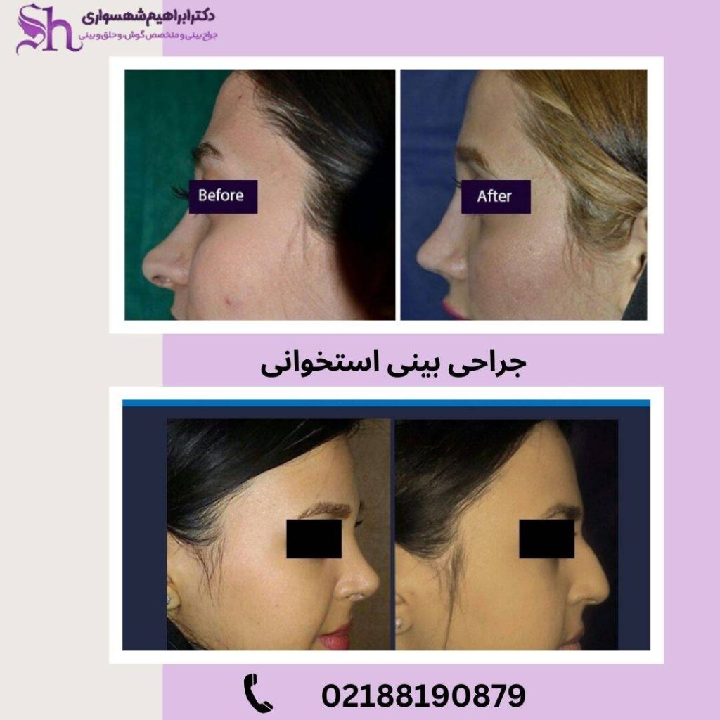 نمونه جراحی بینی استخوانی