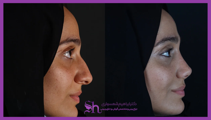 قبل و بعد عمل بینی نمونه کار دکتر ابراهیم شهسواری