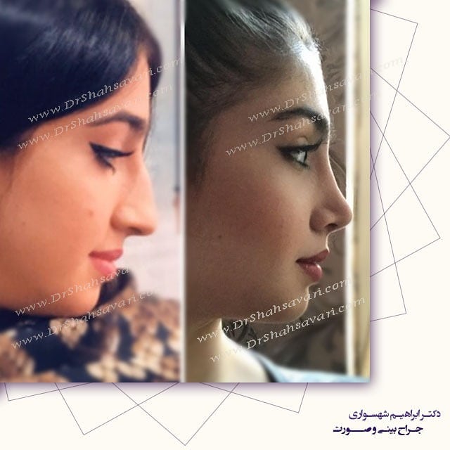 جراحی بینی استخوانی بعد از عمل