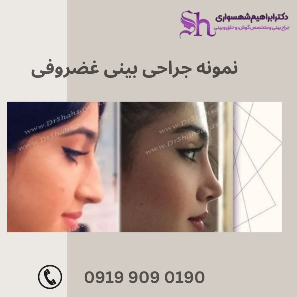 نمونه کار عمل بینی غضروفی