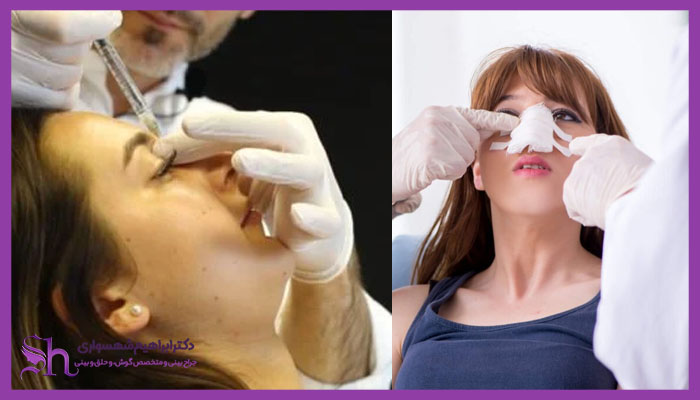 هزینه تزریق آنزیم بعد عمل بینی چقدر است؟