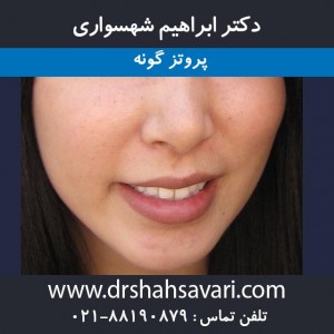 پروتز گونه