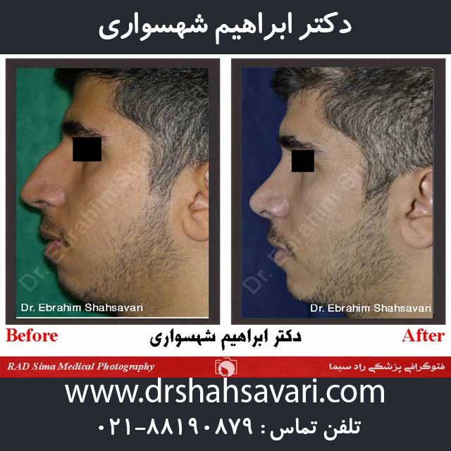 قبل و بعد جراحی بینی دکتر شهسواری