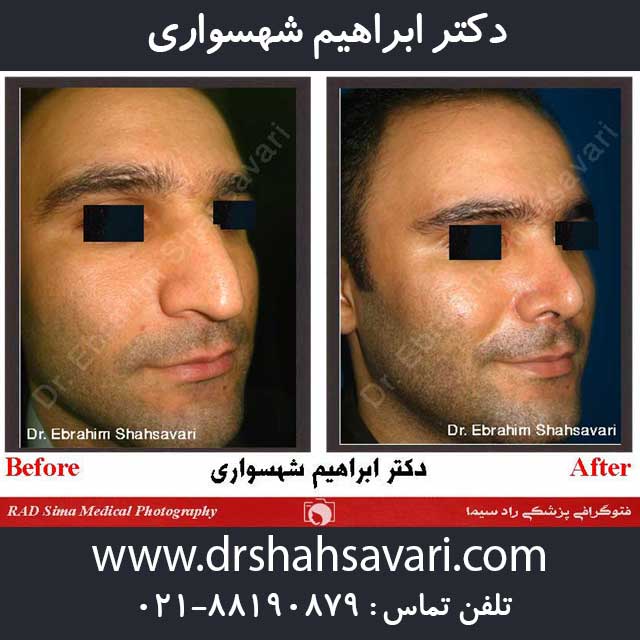 قبل و بعد جراحی بینی مردانه دکتر شهسواری