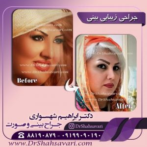 جراحی بینی