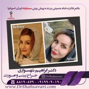 عمل بینی
