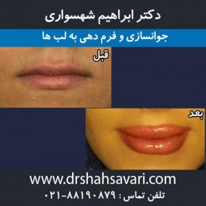تزریق ژل و چربی