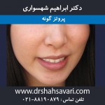 پروتز گونه